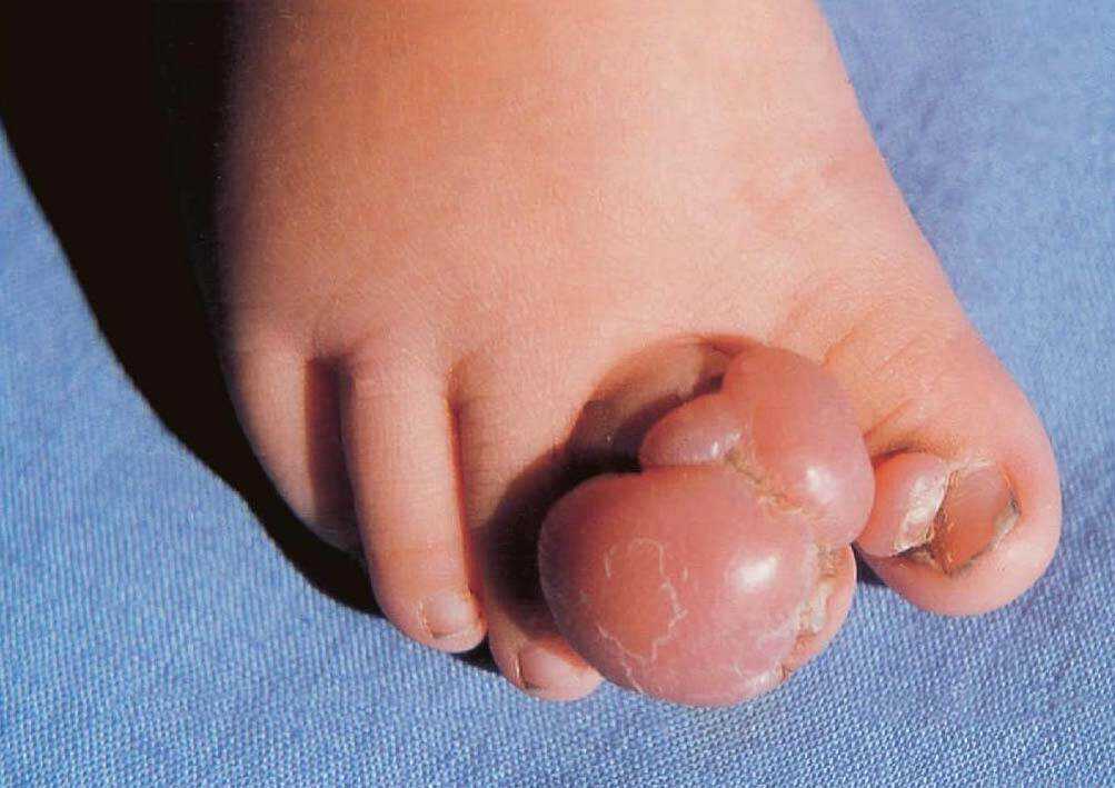 婴儿指(趾)纤维瘤病-临床皮肤病学-医学